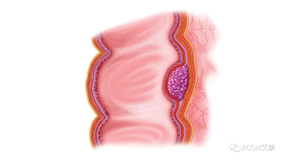 因?yàn)楹鲆暽眢w出現(xiàn)的這些變化，他們最后被確診結(jié)腸癌
