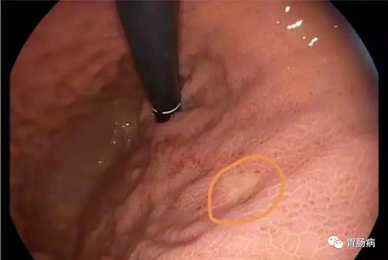 醫(yī)生總結(jié)了3位年輕胃癌患者的病例：30歲不到的他們到底干啥了？