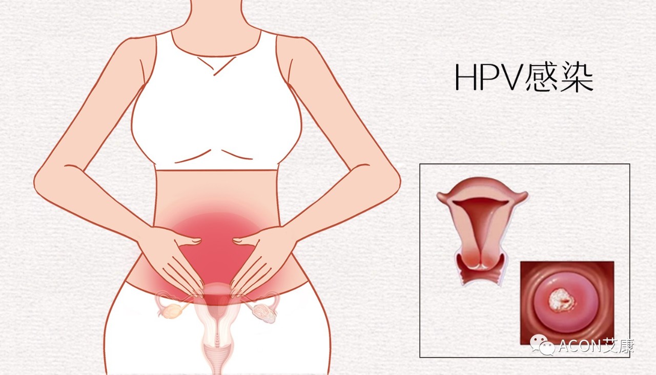 HPV轉(zhuǎn)陰其實(shí)很簡單， 女性必知的宮頸癌真相