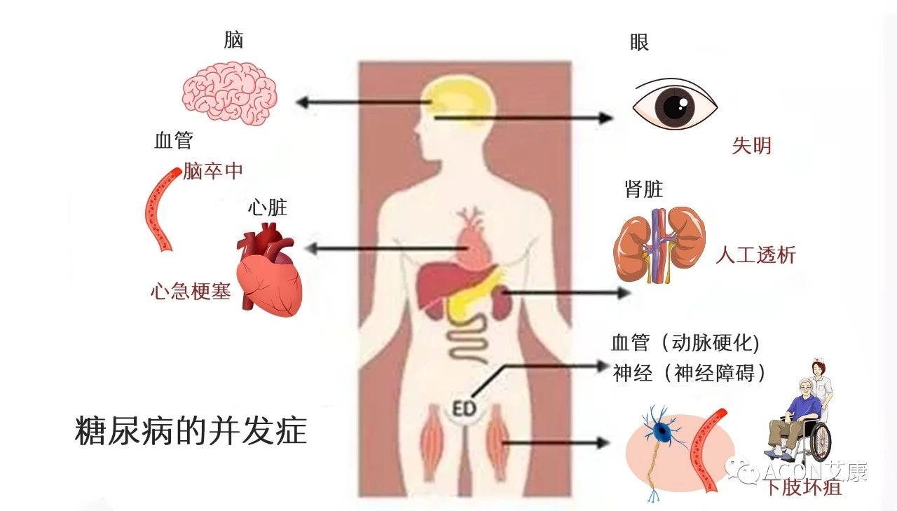 爆上熱搜，因爆發(fā)型糖尿病進入ICU，有哪些教訓(xùn)值得我們汲取