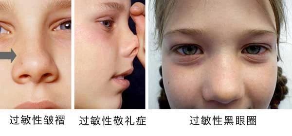 過敏性鼻炎會(huì)讓孩子變傻？！家長(zhǎng)該如何應(yīng)對(duì)